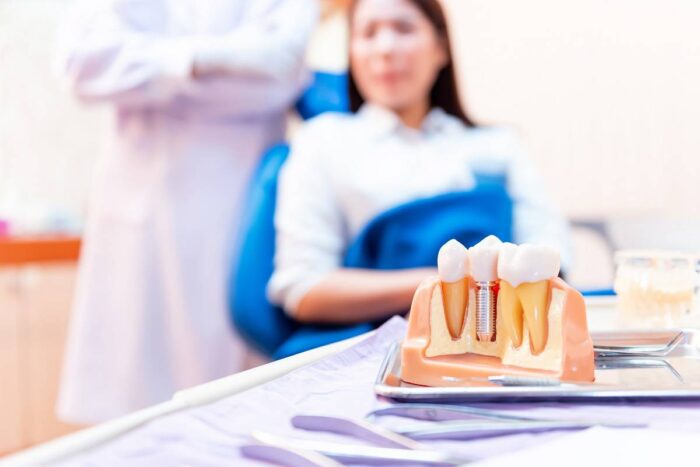 How To Get Affordable Dental Implants: Cost Breakdown