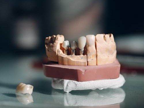 How To Get Free Mini Dental Implant Procedures