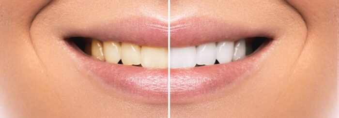 What Issues Can A Smile Makeover Improve?