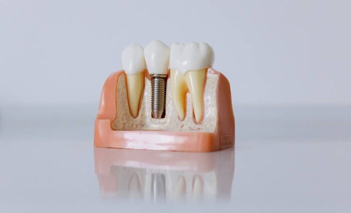 Types Of Dental Implants: Understanding The Best Option For You