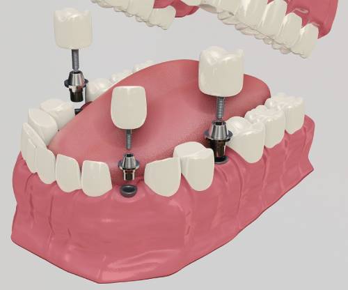 Government Grants Offering Free Dental Implants For Low-income Individuals