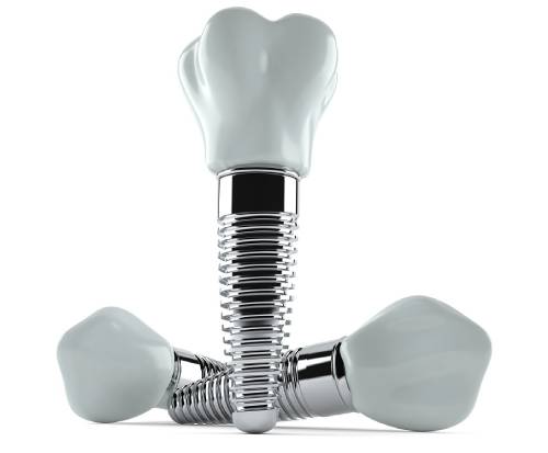What Is The Cost Of Dental Implants
