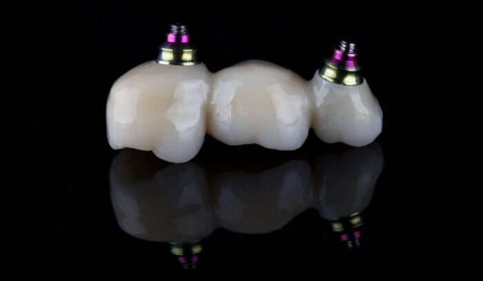 Dental Implant Bridges Cost