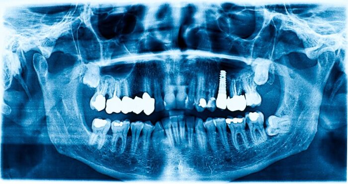 How Much Does Insurance Pay For Dental Implants?